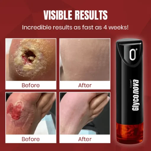 Lyyeto® Glyconova Blood Sugar Inhaler