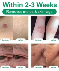 Lyyeto® Herdle Shot Spot & Mole Correct Serum