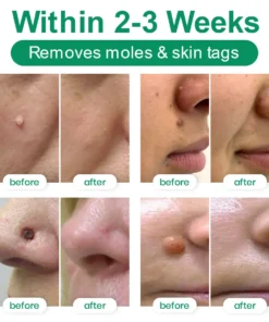 Lyyeto® Herdle Shot Spot & Mole Correct Serum